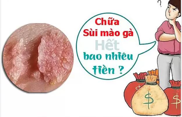 Chi phí chữa bệnh sùi mào gà hết bao nhiêu tiền năm 2026?