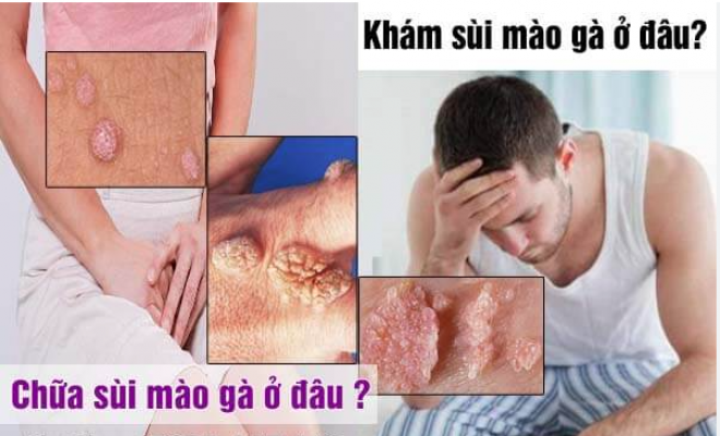 9 địa chỉ khám chữa bệnh sùi mào gà ở đâu tốt nhất tại Hà Nội