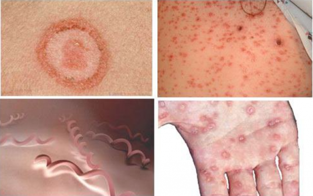 10 Địa chỉ xét nghiệm, khám bệnh giang mai ở đâu tốt nhất Hà Nội