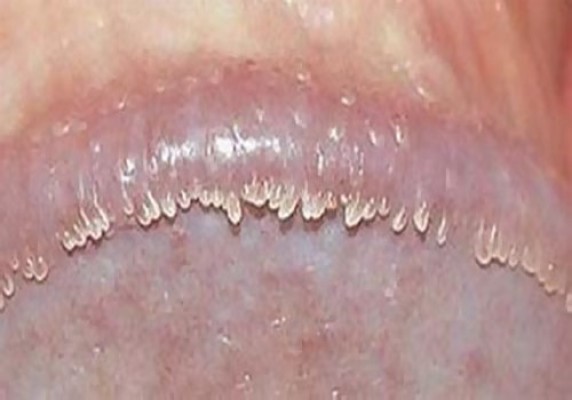 Hình ảnh mụn gai sinh dục ở môi bé nữ giới chi tiết